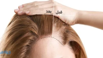 ترميم الشعر