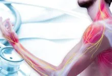 التهاب الأعصاب